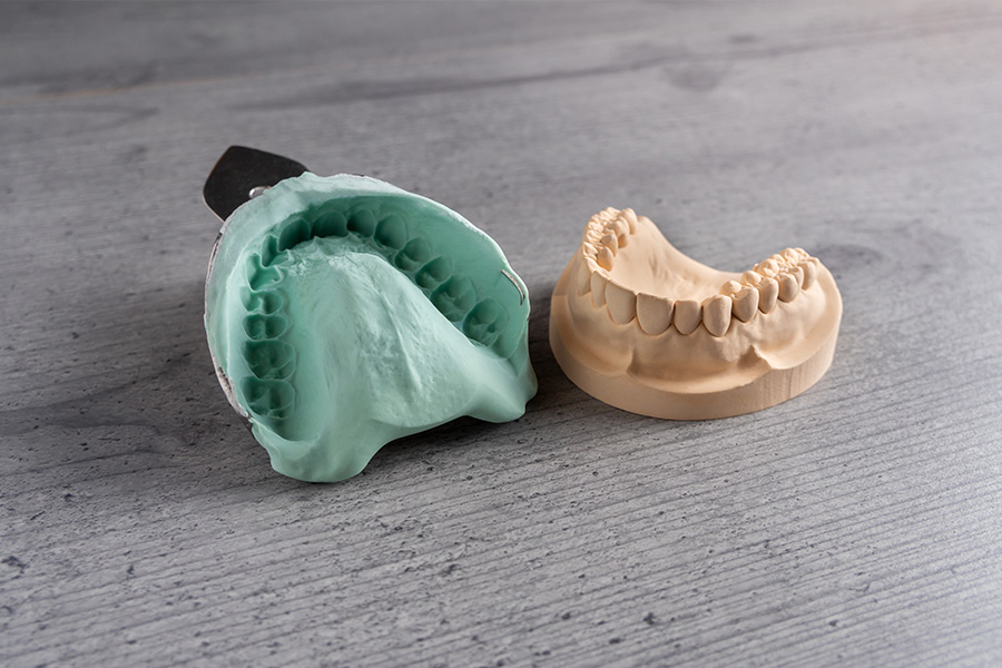 型取り(印象採得)